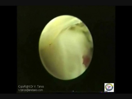Embryoscopy