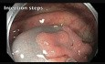 Colonoscopy - Ascending Colon - Flat lesion - Step I - Evaluation & Injection