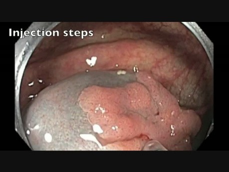 Colonoscopy - Ascending Colon - Flat lesion - Step I - Evaluation & Injection