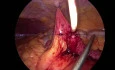 Laparoscopic Direct Feeding Jejunostomy 