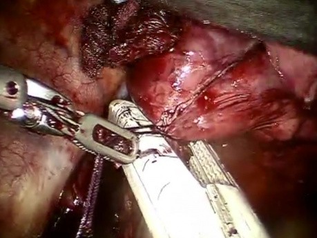 Robotic Right Pneumonectomy