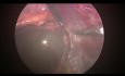Retroperitoneal Laparoscopic Surgery For Adrenal Cystectomy