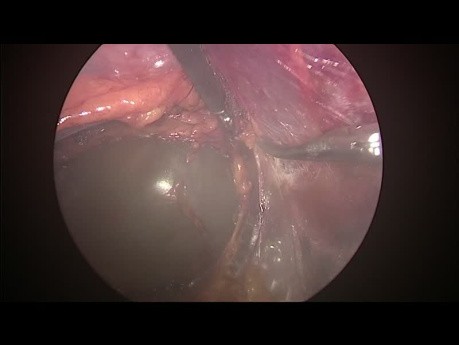 Retroperitoneal Laparoscopic Surgery For Adrenal Cystectomy
