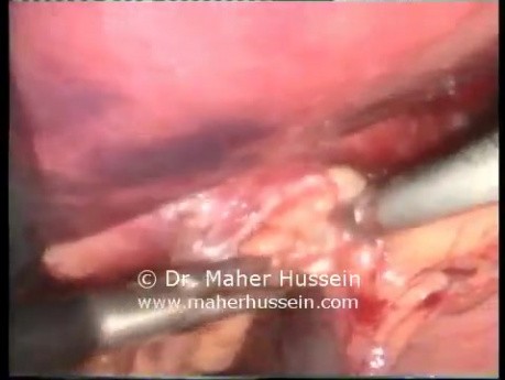 Incarcerated Hiatus Hernia Repair - Laparoscopic Approach