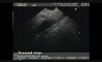 Pancreatic Cancer: EUS-guided Fine Needle Aspiration and Celiac Plexus Neurolysis