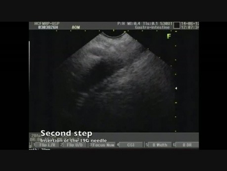 Pancreatic Cancer: EUS-guided Fine Needle Aspiration and Celiac Plexus Neurolysis
