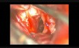 Brain Aneurysm (Anterior Communicating Artery Aneurysm) - Clipping
