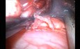 Uniportal VATS Subcarinal Lymph Node Dissection