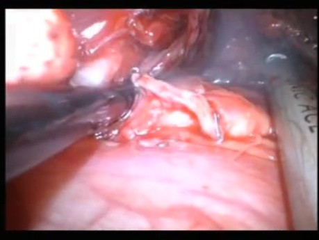 Uniportal VATS Subcarinal Lymph Node Dissection