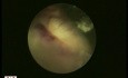 Endoscopy