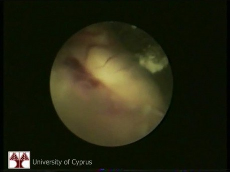 Endoscopy