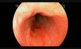 Esophageal Ulcerations - Case