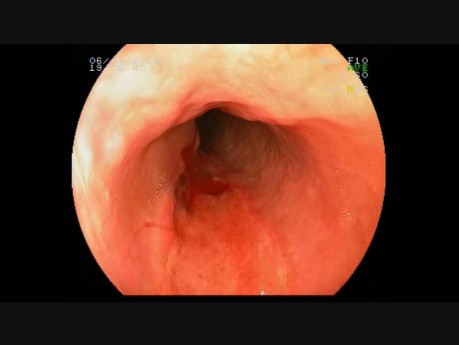 Esophageal Ulcerations - Case