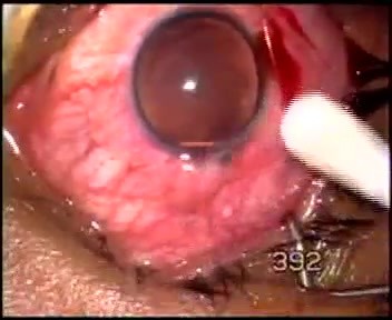 Aniridia - transciliary filtration
