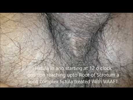 Ano Scrotal Fistula Upto Root of Scrotum