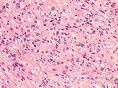 Gastrointestinal Stromal tumor (GIST) (60 of 65)