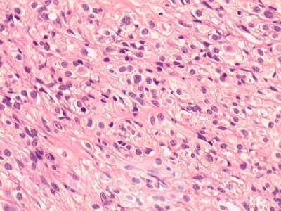 Gastrointestinal Stromal tumor (GIST) (60 of 65)