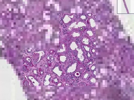 Rapidly progressive glomerulonephritis