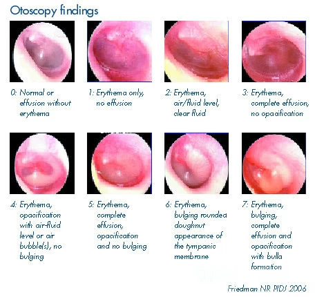 Acute Inflammation of Middle Ear