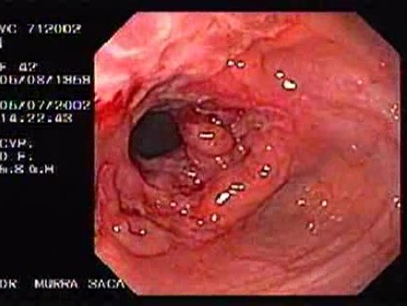 Crohn´s Disease (14 of 28)