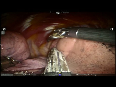 Right Lower Lobectomy