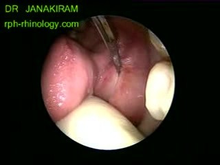Submandibular Ductal Stone