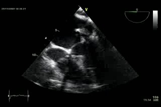 Enormous Mitral Vegetation - Infective Endocarditis