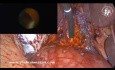 Laparoscopic Common Bile Duct Exploration After Failed ERCP with CBD Primary Closure