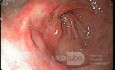 Endoscopy - Erosive Gastropathy