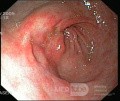 Endoscopy - Erosive Gastropathy