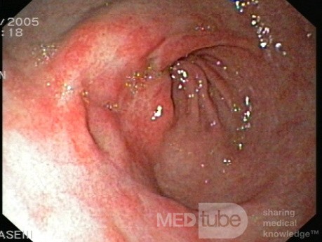 Endoscopy - Erosive Gastropathy