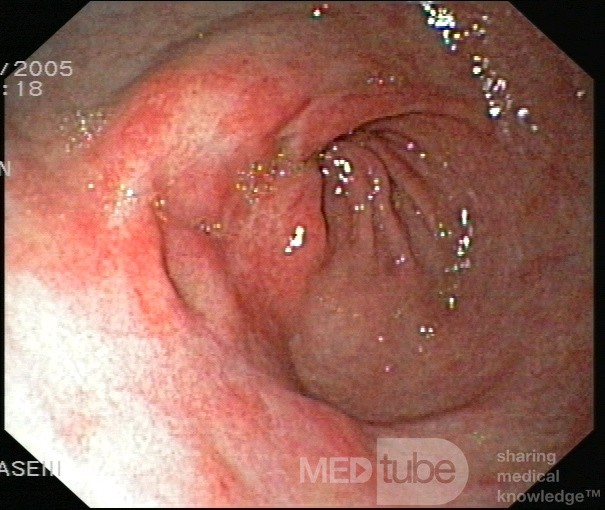 Endoscopy - Erosive Gastropathy