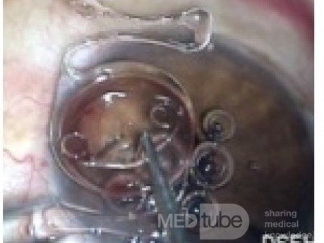 Lens Exchange