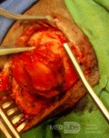 Epicranial Tumor Injury