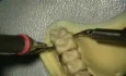 Ultrasonic Endoscopic  Debridement Simulation (UL Palatal, Facial)