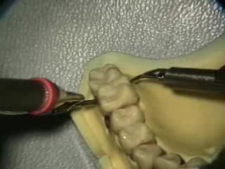 Ultrasonic Endoscopic  Debridement Simulation (UL Palatal, Facial)