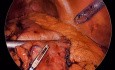 Laparoscopic Sub-total Gastrectomy for Management of Bleeding Polyps
