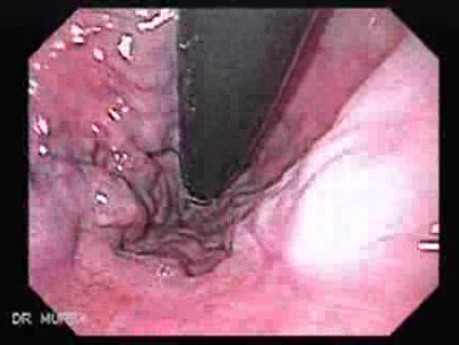 Esophageal Variceal Bleeding - Chains of the Varices