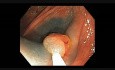Colonoscopy Channel - How To Perform EMR - Lesion C
