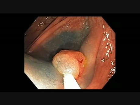 Colonoscopy Channel - How To Perform EMR - Lesion C