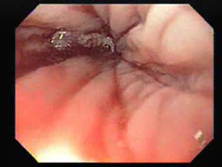 Adenocarcinoma of the Esophagus and Gastric Fundus (2 of 3)