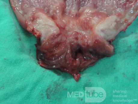 Gastric Ulcerated Adenocarcinoma of the Pre-pyloric Antrum (24 of 28)