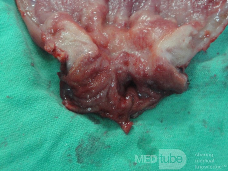 Gastric Ulcerated Adenocarcinoma of the Pre-pyloric Antrum (24 of 28)