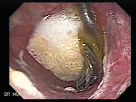 Esophageal Stent - Gastroscopic Retroflexy
