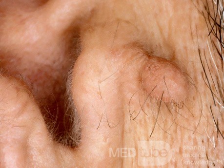 Preauricular Tag
