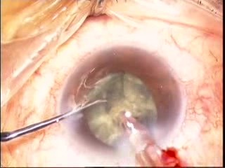 Phacoemulsification - Ozil IP