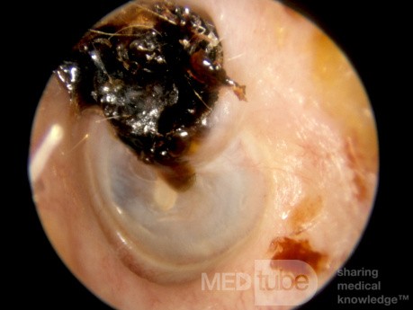 Attic Crust Hiding Cholesteatoma