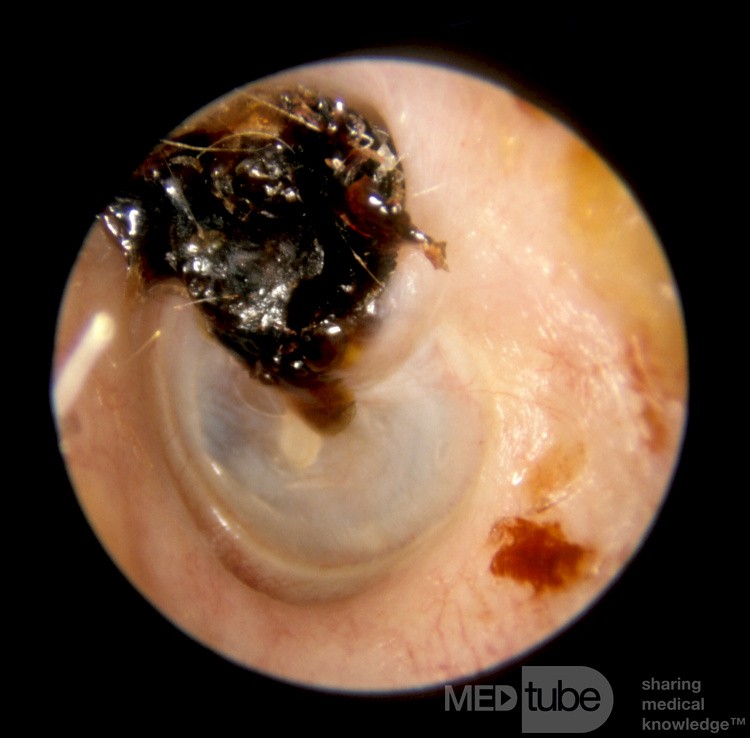 Attic Crust Hiding Cholesteatoma