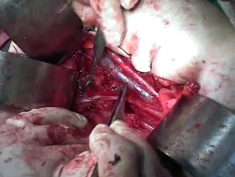 Radical Surgery with Anatomy Lecture - Pelvic Vessels and Structures