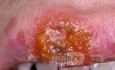 Early Herpes Simplex Upper Lip [Closer View]